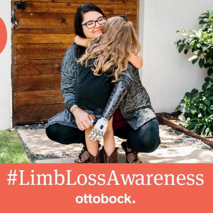 Rob, wearing his empower foot, uses his laptop