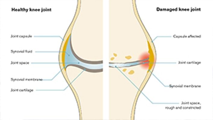 What is osteoarthritis? Ottobock.
