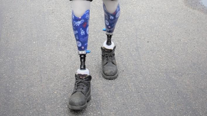 Bilateral leg amputee, Mark ANdersen, wearing his Meridium feet and LA dodgers themed sockets